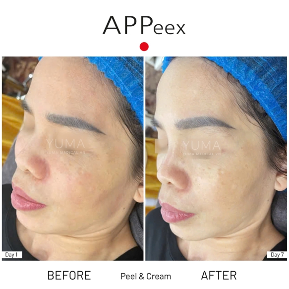 APPeex Peel